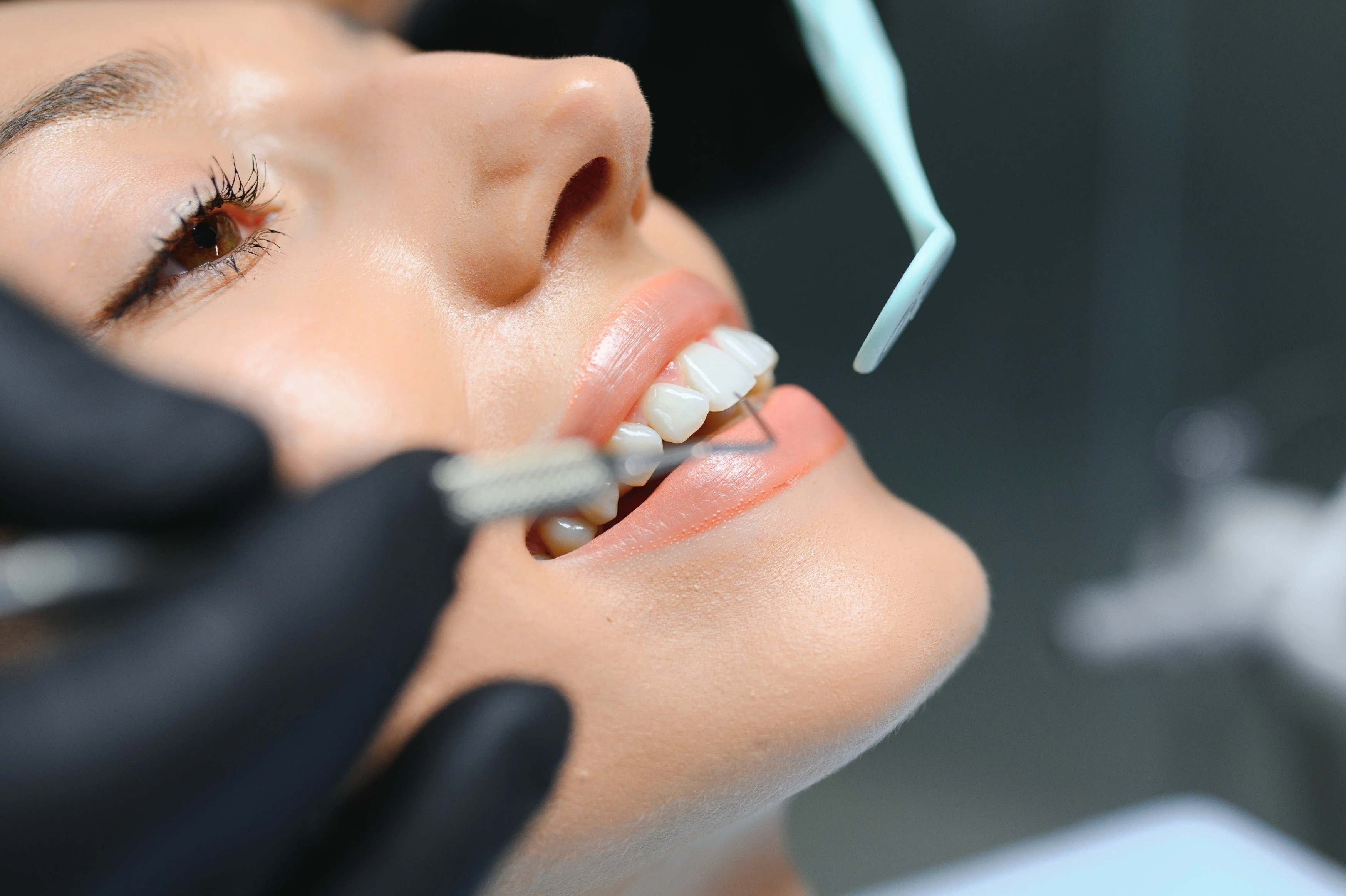 Porcelain Veneers